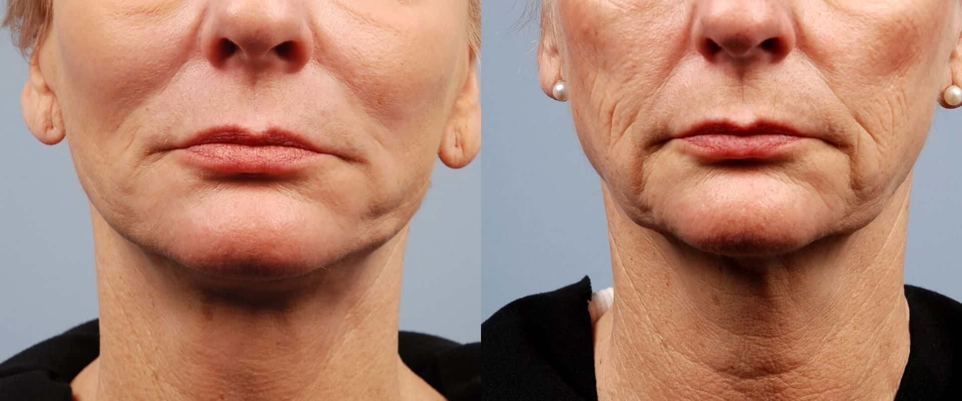 Can You See Results After One Morpheus8 Treatment?