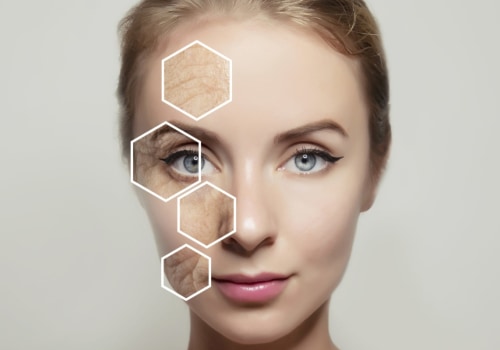 Morpheus8: The Latest Trend in Technology for Dissolving Filler