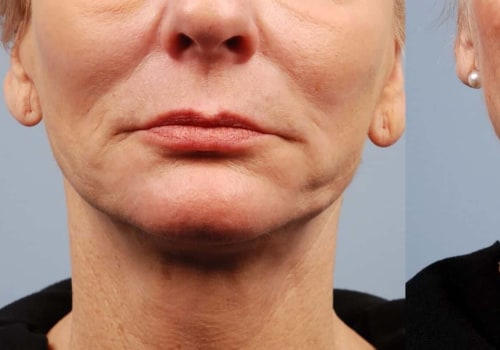 What is the Morpheus8 Microneedle Treatment?